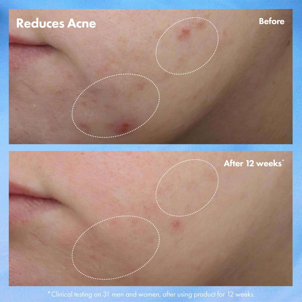 'Clear Improvement™ Acne Clearing Hydrating' Face lotion - 50 ml