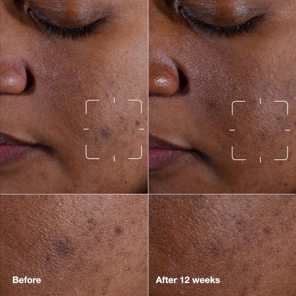 'Even Better Clearing' Anti-Fleck-Serum - 30 ml