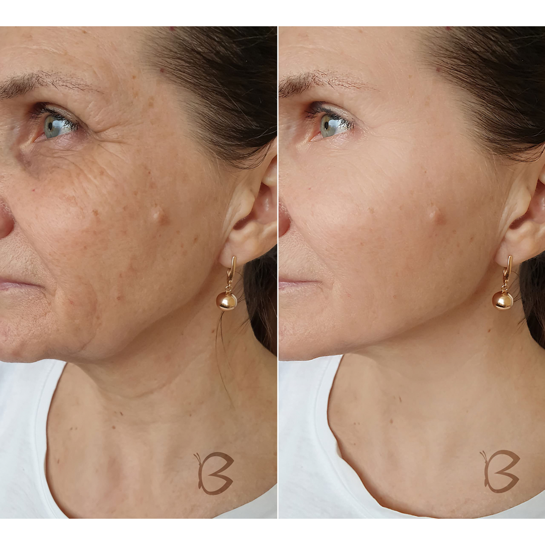 Dispositif de rajeunissement facial par mésothérapie avec micro-aiguilles Meso Pro