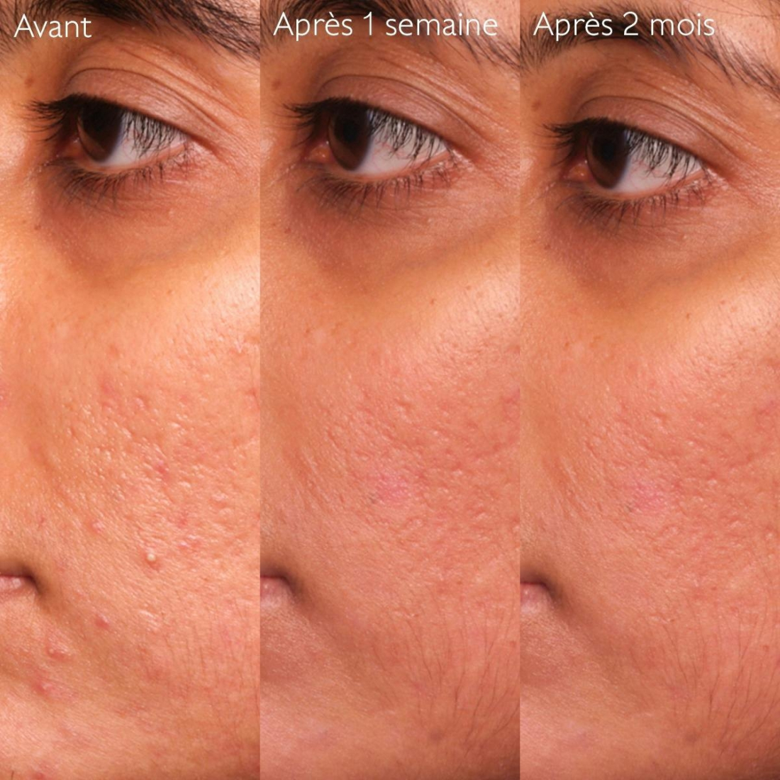 Vinopure Sérum à l'Acide Salicylique Anti-Imperfections - 30 ml