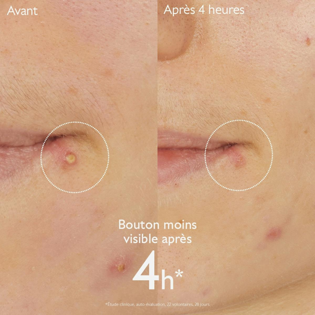 Vinopure Stop Boutons Salicylique l'Acide Salicylique - 15 ml