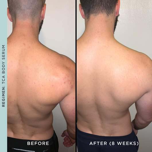 'TCA Lactic & Glycolic' Body Peel - 100 ml