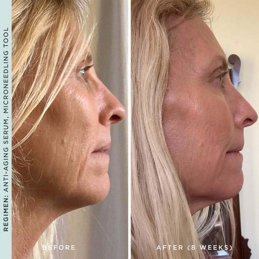 'Microneedling 2.0' Skin Roller