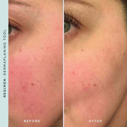 'Dermaplaning' Face Care Device