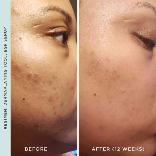 'Dermaplaning' Face Care Device