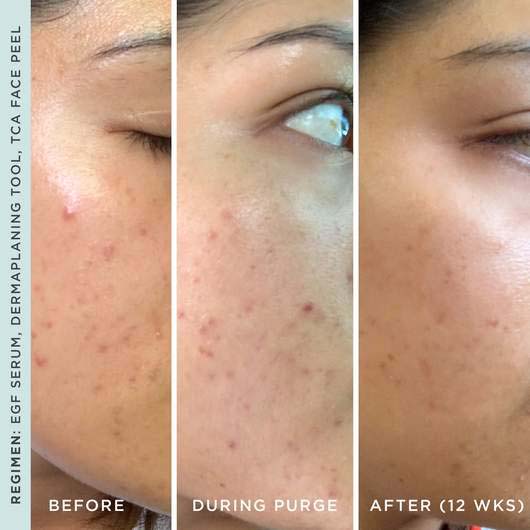 'Dermaplaning' Face Care Device