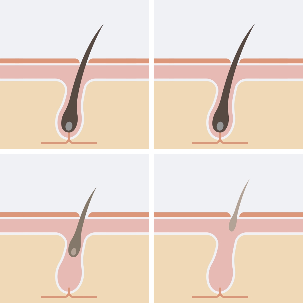 Epilateur a lumiere pulsee 'IPL Revic'